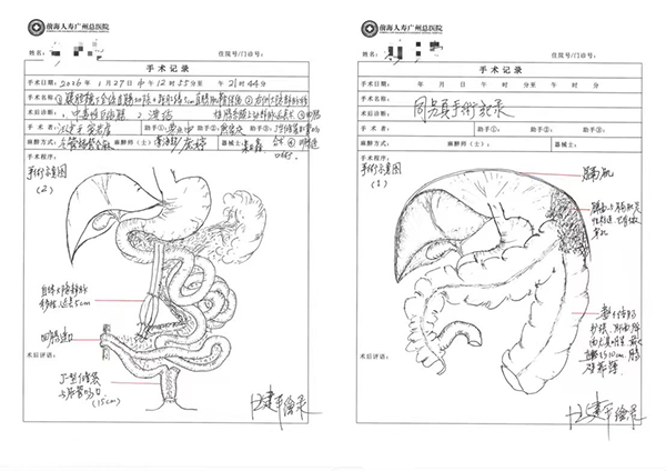 全国首例！前海人寿广州总医院成功救治重症溃疡性结肠炎伴中毒性巨结肠患者