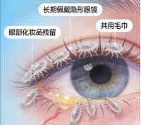 眼表健康新警示：反复眼干眼痒需警惕！蠕形螨检查成眼表精准诊疗关键