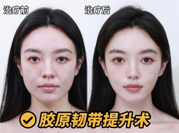 抗衰最怕假面臃肿？台州维多利亚李潮精准塑美自然减龄