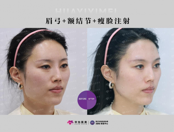 威海瘦脸哪家专业？华怡医美毕建军主任，精准注射打造自然小V脸