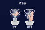 贵阳东大肛肠医院：饭后百步走，活到九十九？胃下垂患者越走越“坠”！