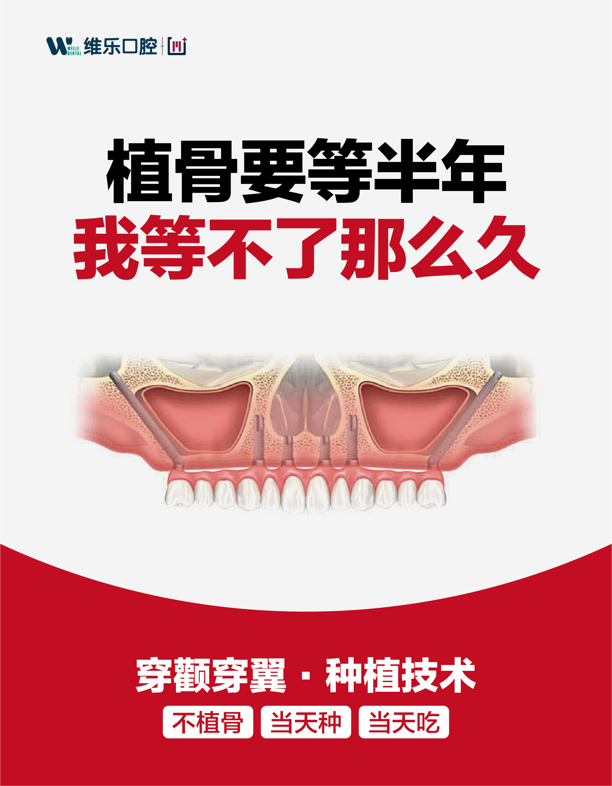 北京维乐口腔全国连锁，穿颧穿翼种植解决骨量不足缺牙难题