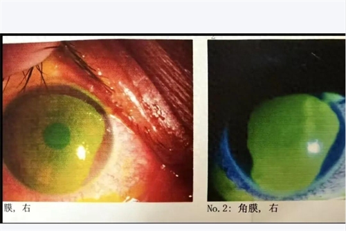 女子称沐浴露入眼致眼角膜烧伤后续，品牌自证产品安全合规