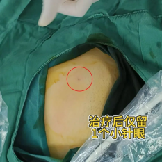 子宫差点没了！子宫肿块千万别乱治！多少女性踩了同款大坑