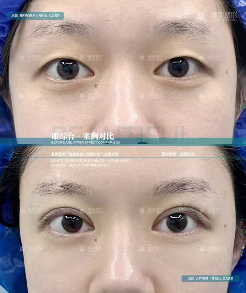 疤痕体质能做双眼皮吗？体质判定+留疤风险+避坑指南｜怀化德美整形肖文波院长专业解答