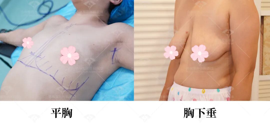 今日乳腺胸vs脂肪胸深度科普！杏林隆胸